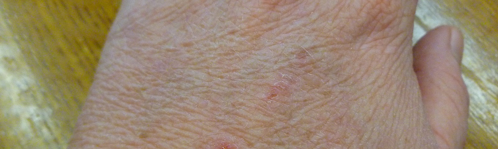 A close-up of a person’s hand shows the skin details clearly, and there are several red marks or blemishes visible on the back of the hand. The skin texture is wrinkled, and the photograph captures various skin tones and lines, suggesting a mature age for the individual.