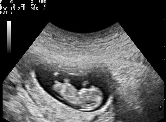 An ultrasound of a pregnant woman revealing an image of the fetus