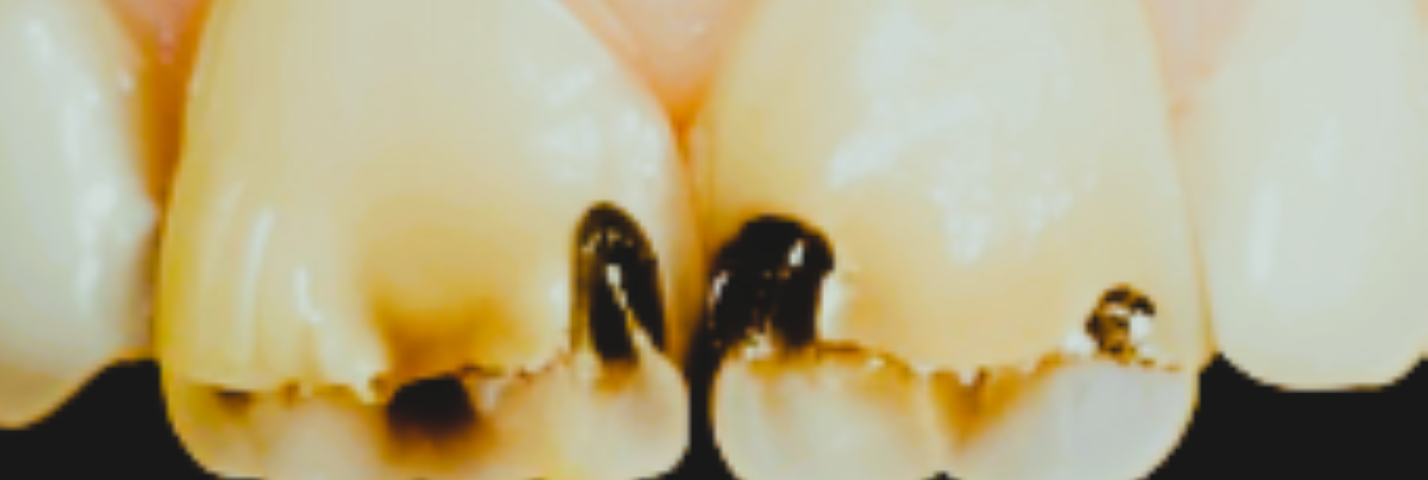 Image shows the inside of a mouth with two front teeth that have black spots and what looks like damaged enamel.