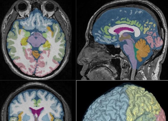 Cerebrospinal fluid MRI scan where different areas of the brain are colour-coded using DL