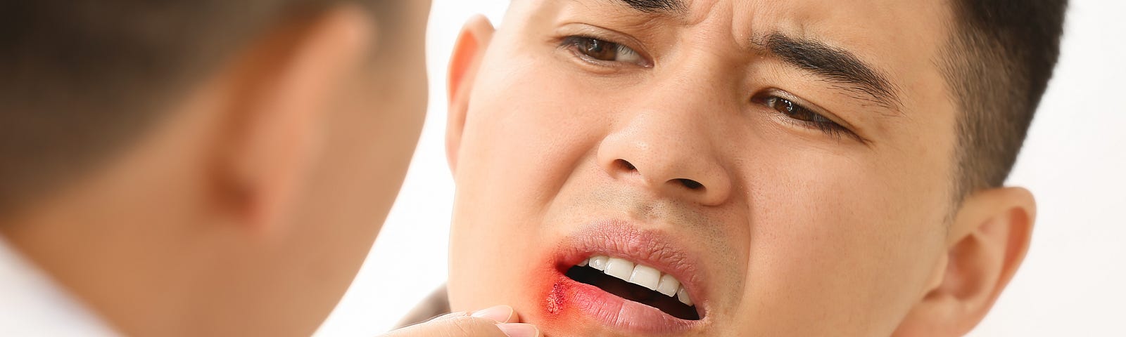 An Asian man with a cold sore looks at his reflection in a mirror.