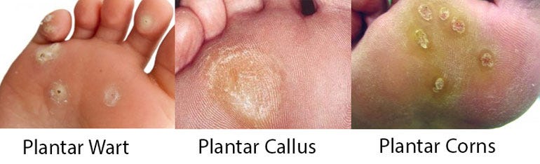 Callus is a skin disease in which the skin gets thickened by the regular fr...
