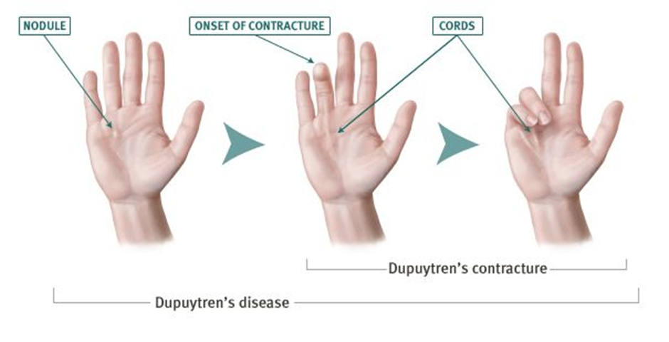 Diagram showing three palms at progressive stages of Dupuytren’s Disease. 1st palm shows palm nodules. 2nd palm shows slight contraction of ring finger. 3rd palm shows ring and small finger contracted into palm.