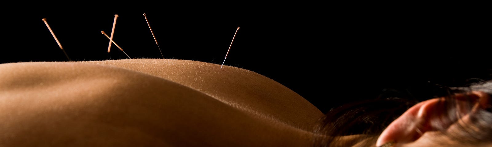 A closeup of acupuncture needles in a woman’s upper back.