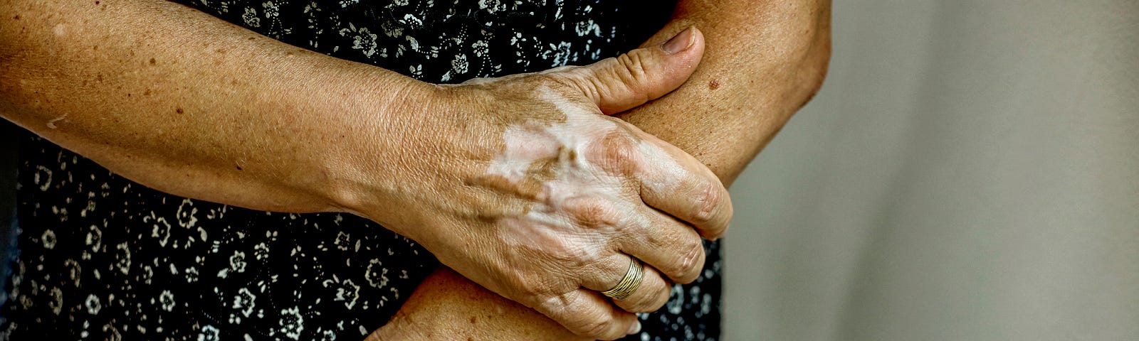 A close up of a woman’s arms and hands with vitiligo.