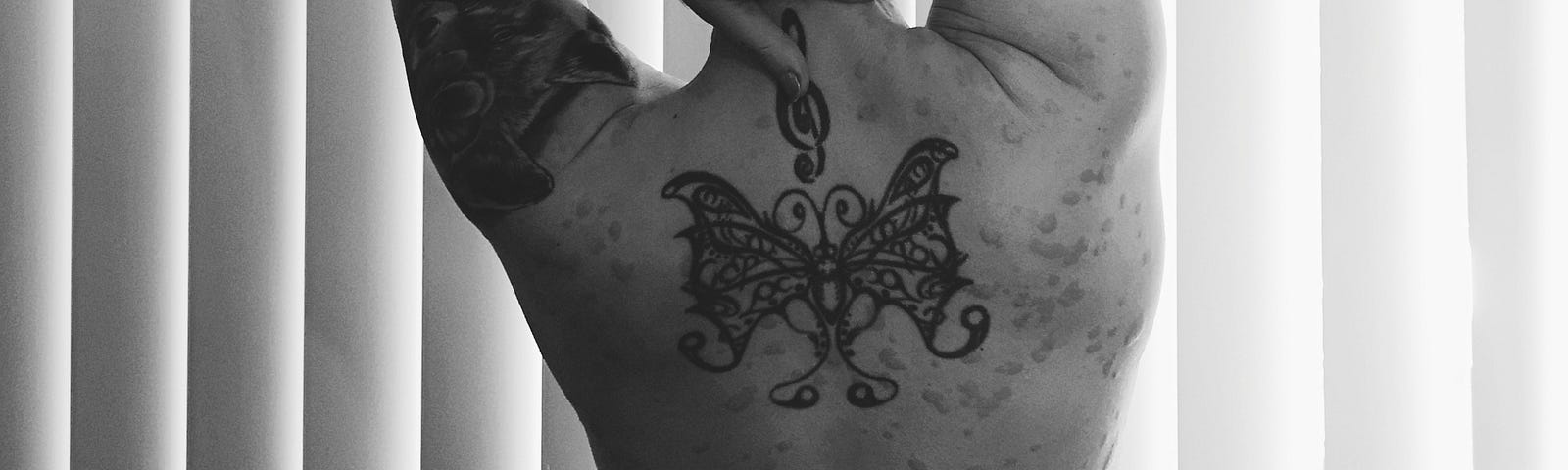 A photo of the author’s bare back. She has 2 large tattoos on her upper back and upper left arm, and hives on her skin.