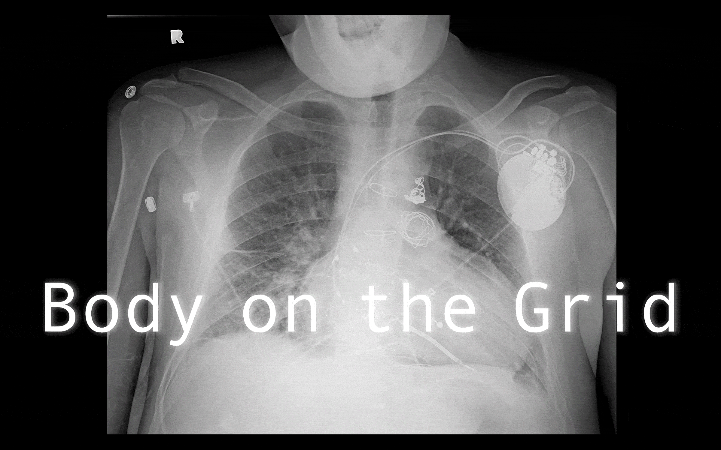 An x-ray of the author’s chest, with the text “Body on the Grid” juxtaposed over the image.