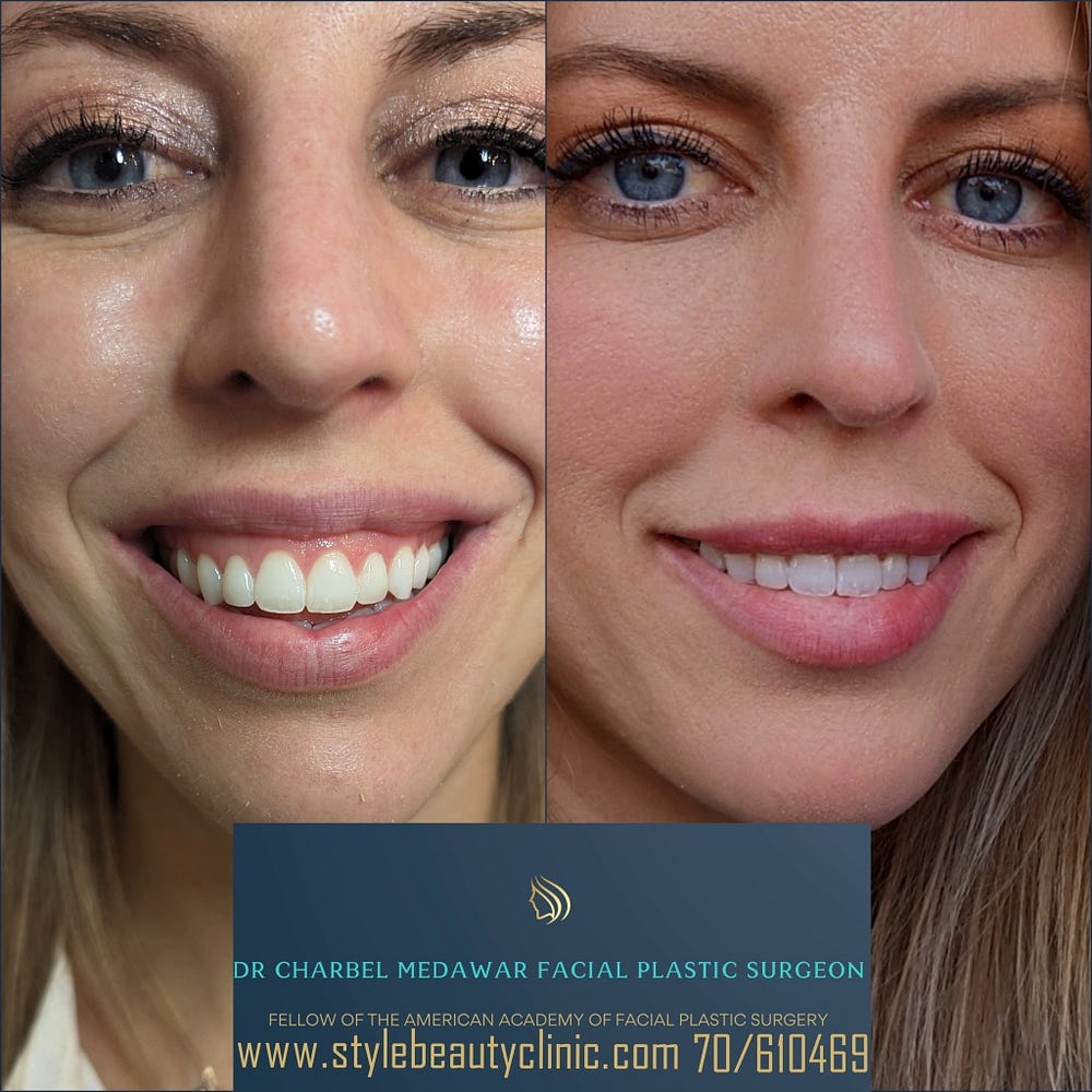 heidi bitton dr charbel medawar gummy smile Botox