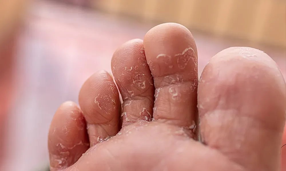 representation of athlete’s foot