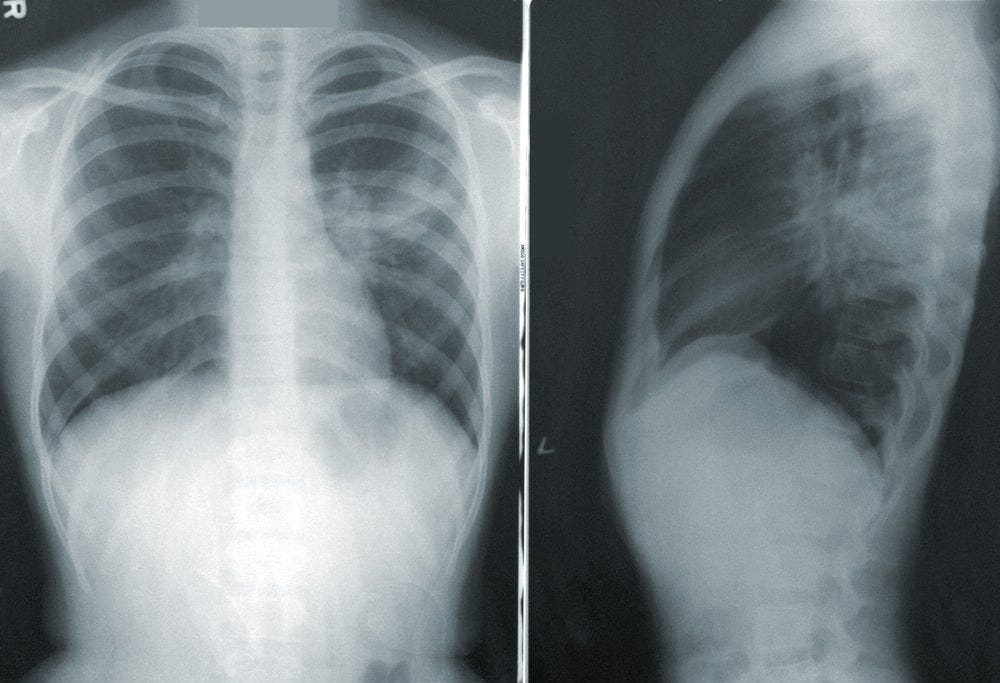 Chest X-Rays with Deep Learning – mc.ai