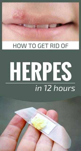 Home Remedy To Get Rid Of Herpes In 12 Hours