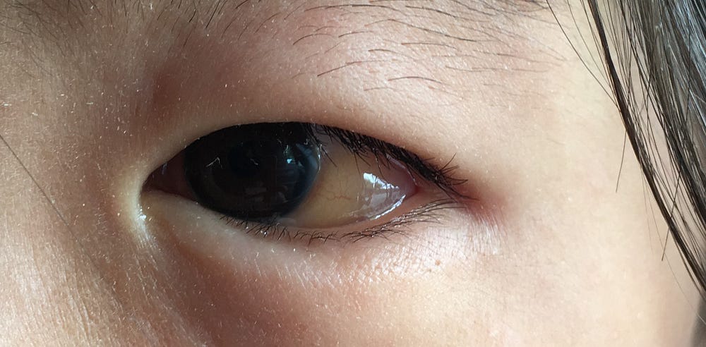 The sclera is changing color...