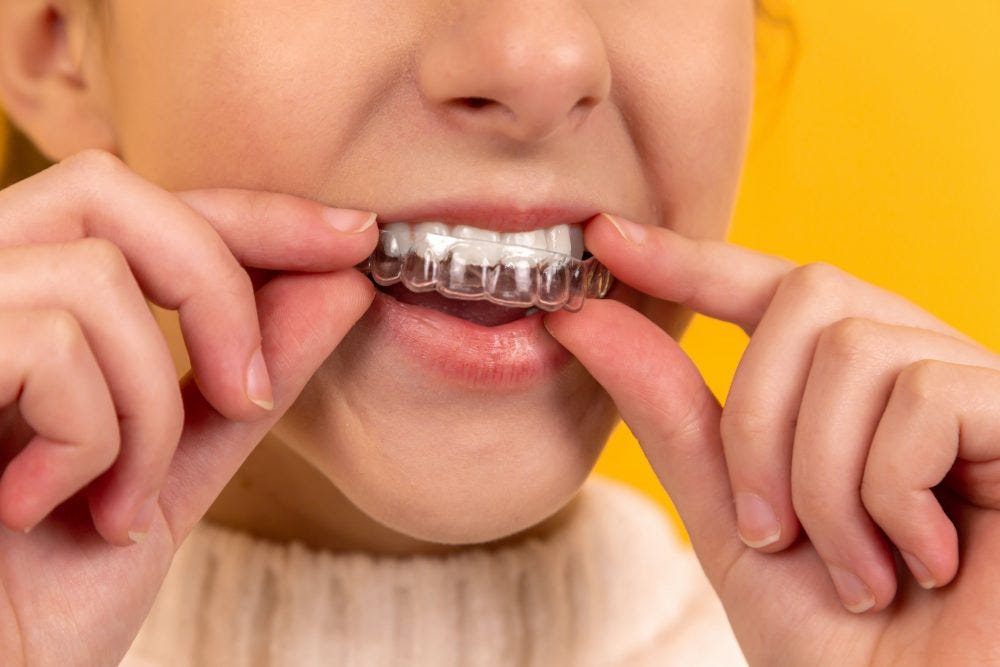 Braces or Aligners Treatment in Mohali — 32 Sparklets | Dentist In Mohali | Best Dentist in Mohali