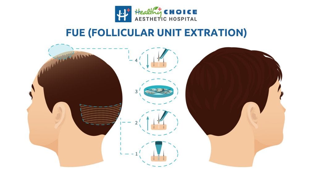 best hair transplant in nepal fue follicular unit extration