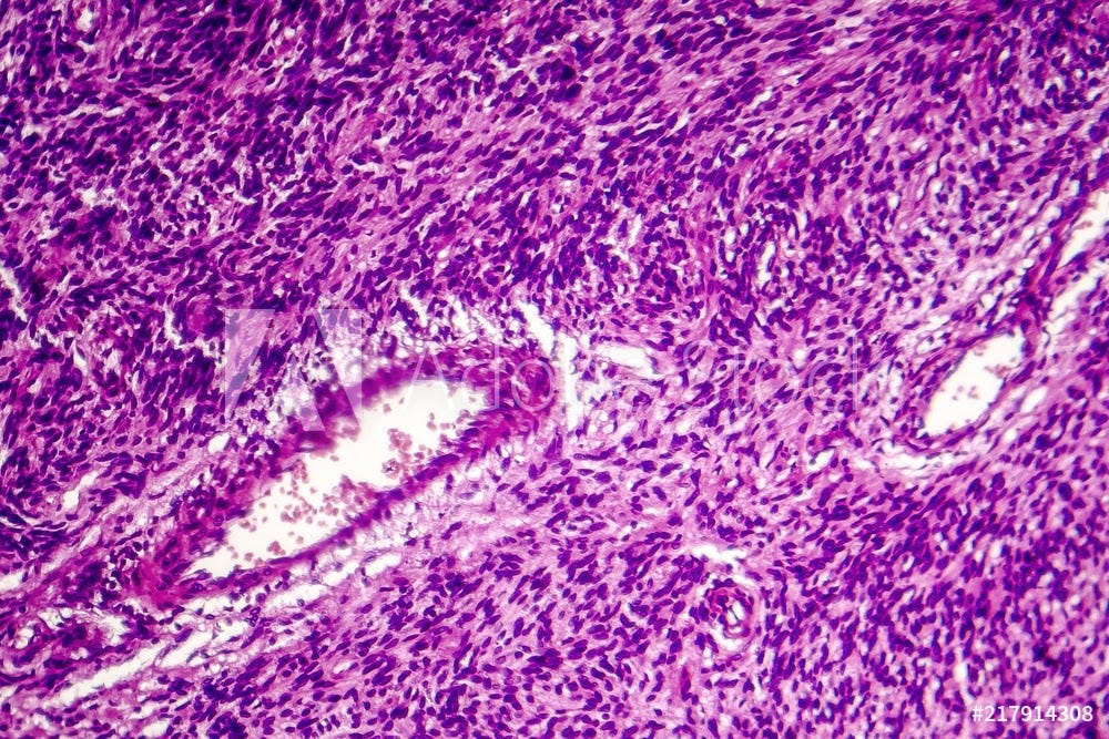 fibrosarcoma cells under a microscope