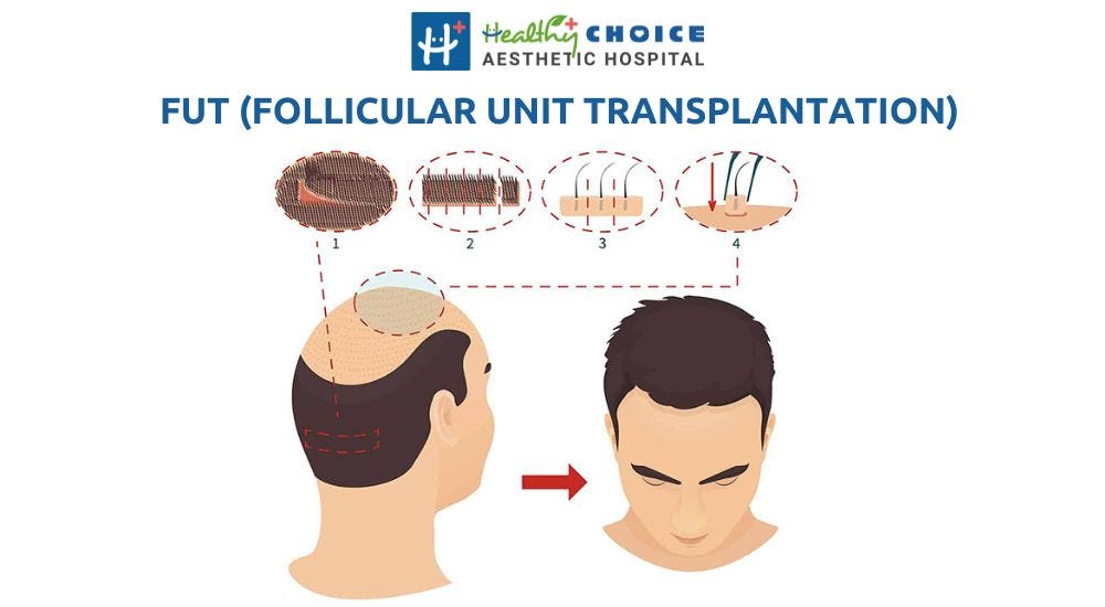 best hair transplant in nepal fut follicular unit transplantation