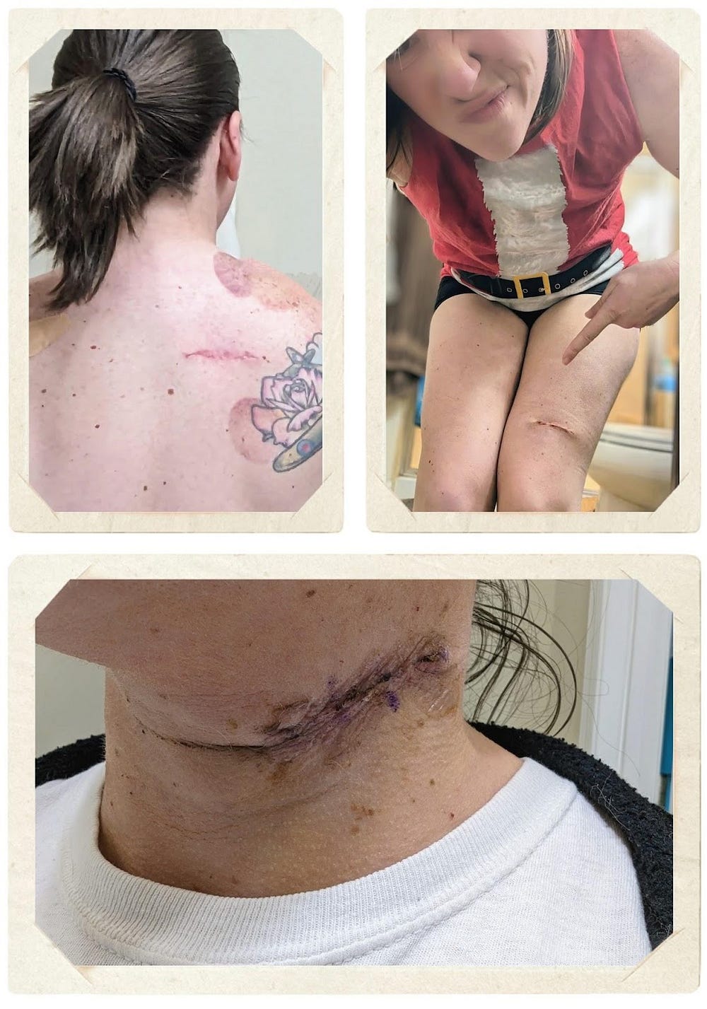 Post surgery images of Heather Gioia, author. In the upper left is the scar from the Stage 0 surgery on her upper left shoulder. The upper right is a picture of the scar from the Stage 0 surgery on her left thigh. At the bottom is a picture of the scar on the left side of her neck from the Stage 1 surgery.