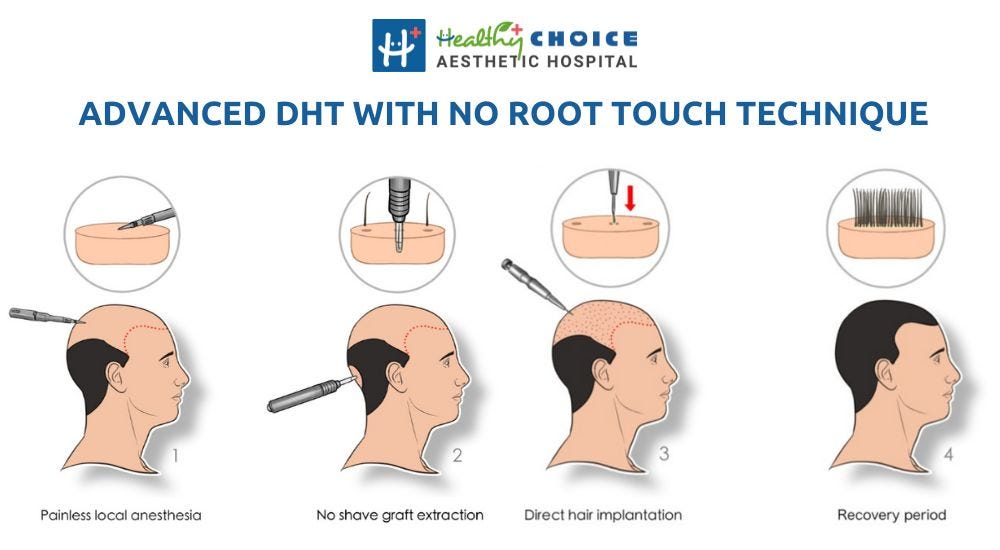 best hair transplant in nepal DHT with no Root touch technique