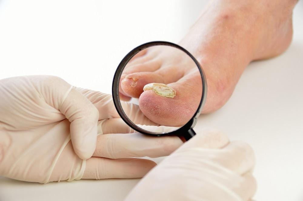Stop Toe Fungus from Spreading Tips and Prevention Methods