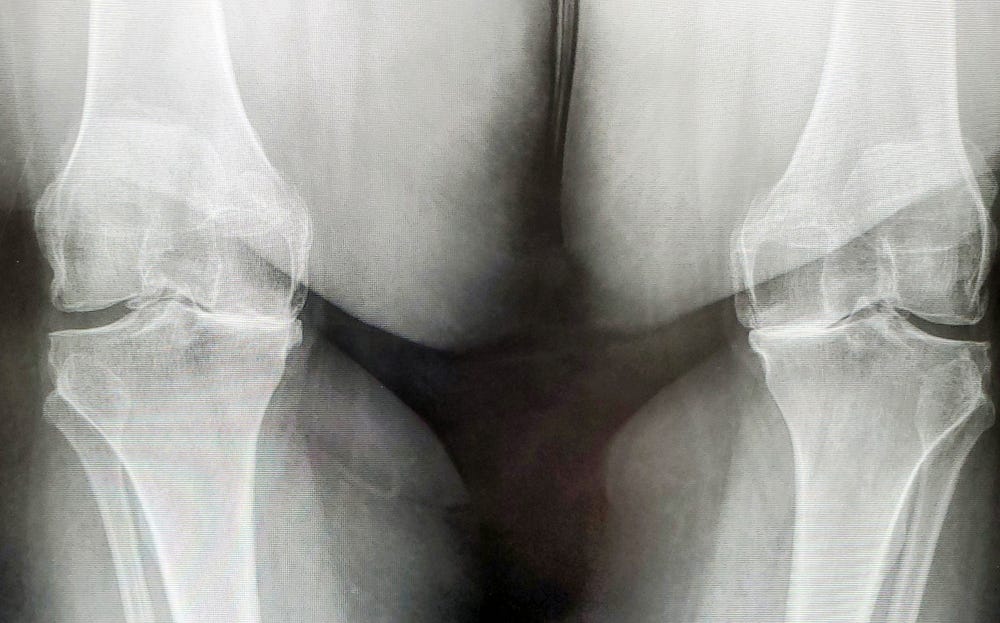 An X-ray of two knee joints. Both knees have a gap on the outside of the joint and they both have bone on bone on the inside of the joint.