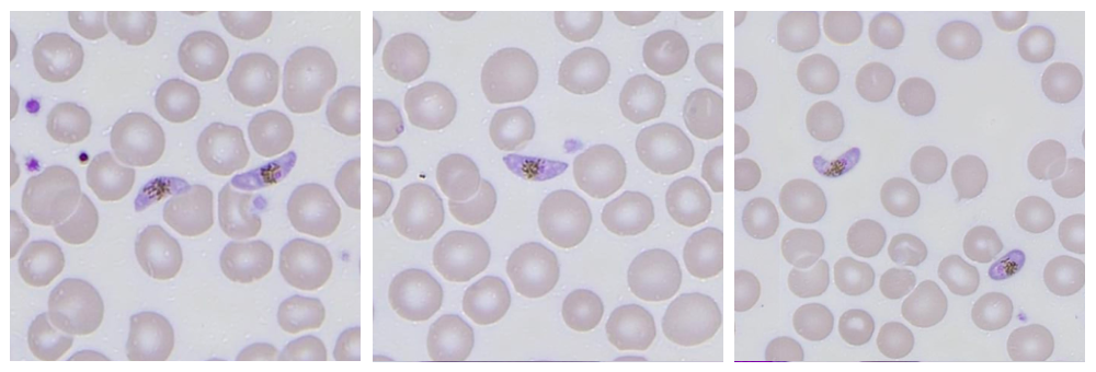 Malaria on the peripheral smear: A pathologist’s guide to morphological identification