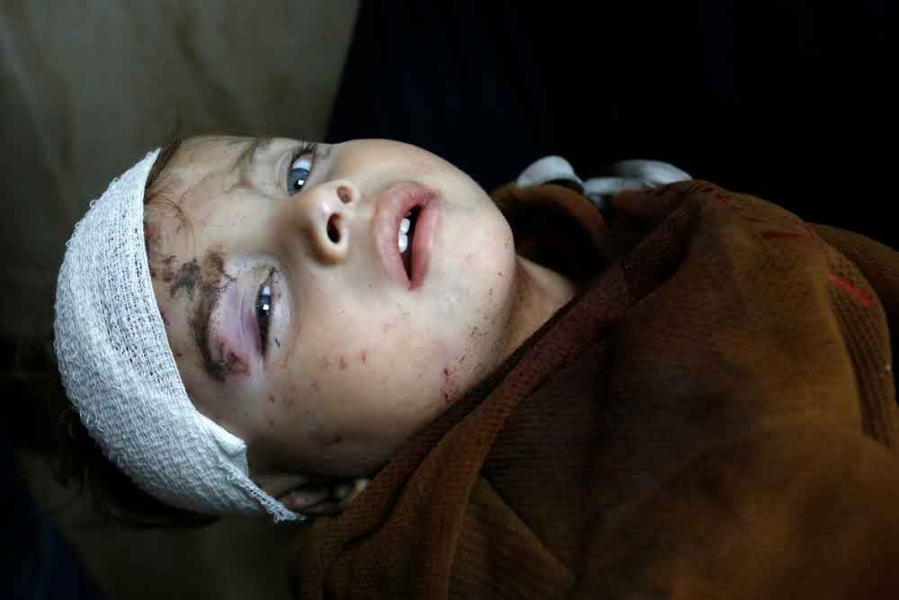 An injured Palestinian child with a bandaged head and bruised eye stares up at the camera receives treatment at Al-Aqsa Martyrs Hospital. [Ashraf Amra/Anadolu]