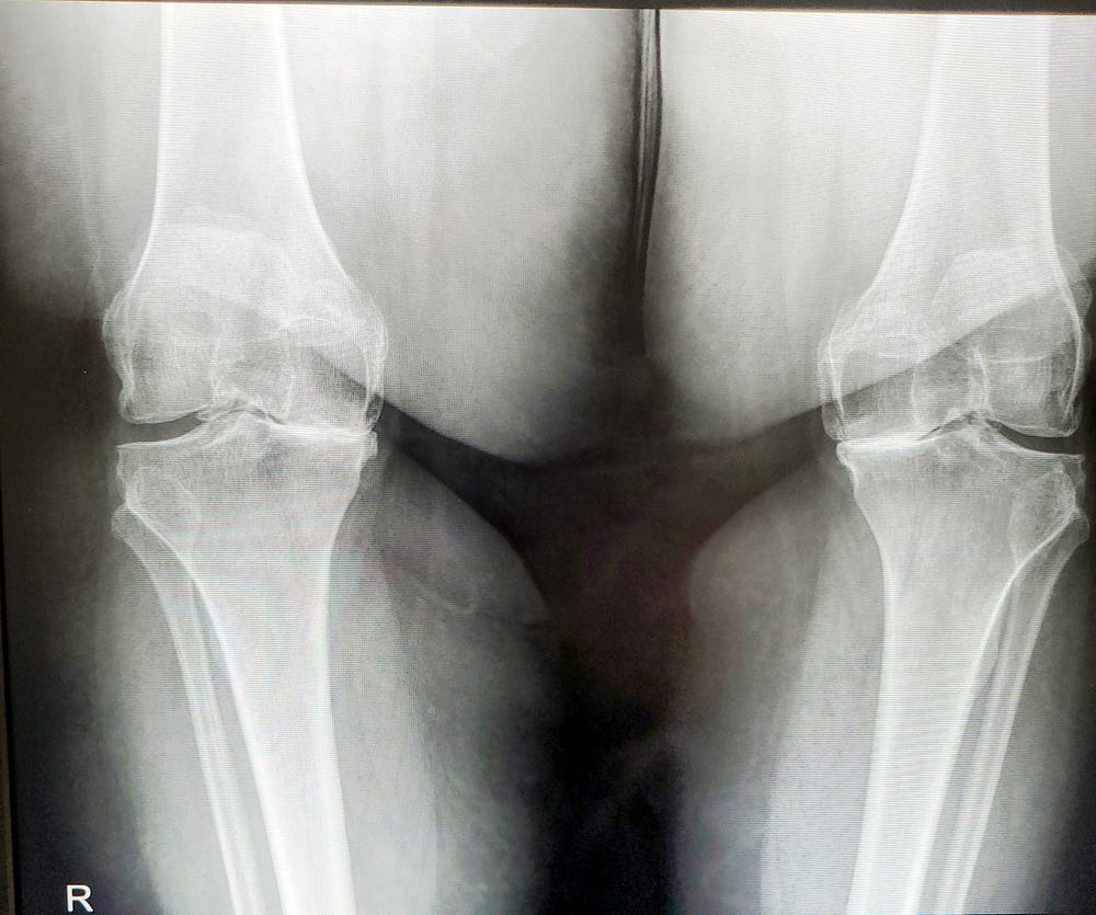 An X-ray of two knee joints. Both knees have a gap on the outside of the joint and they both have bone on bone on the inside of the joint.