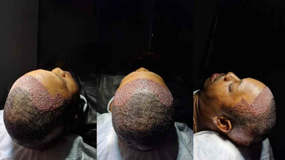 afro hair transplant