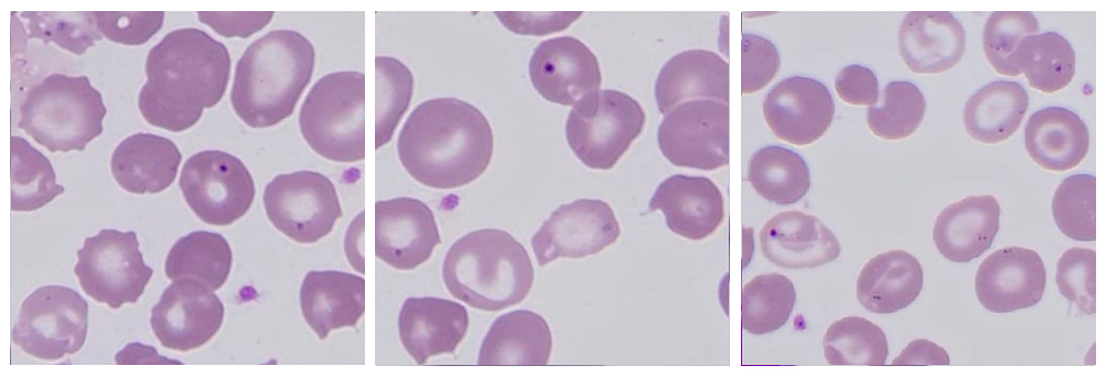 RBC inclusions unveiled: Why peripheral smear still matters?