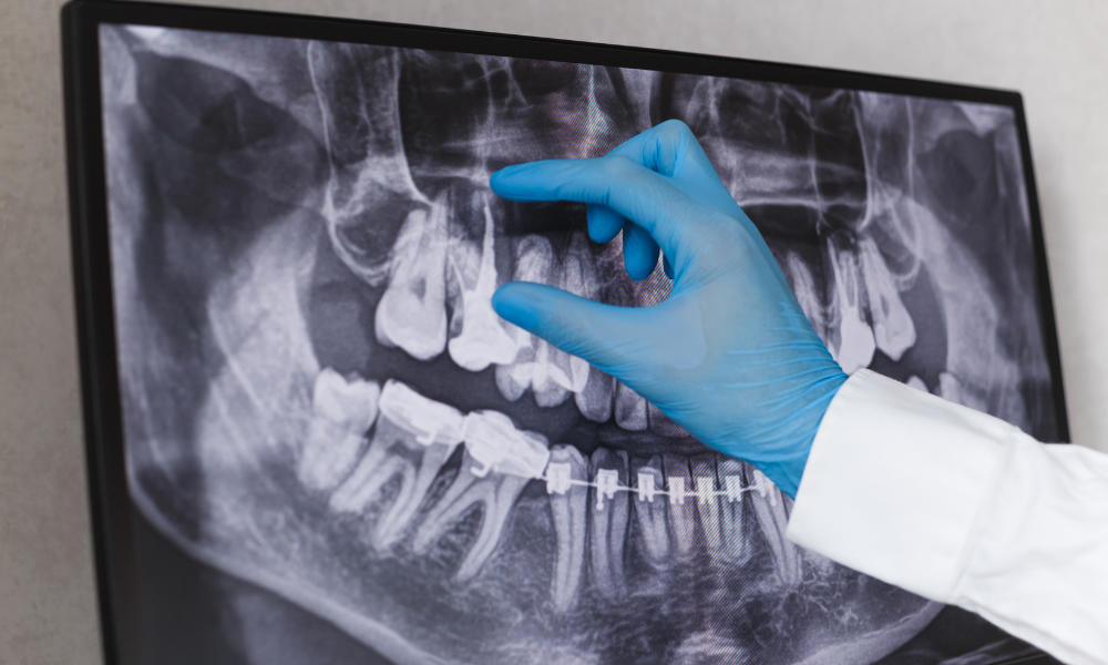 Comprehensive Guide to Root Canal X-rays for Radiologists