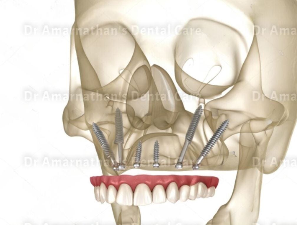 different types of dental implants