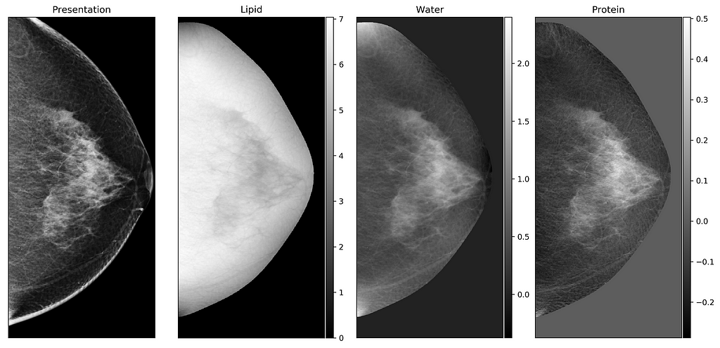 Standard mammogram and its 3CB lipid, water, and protein maps resulting from dual-energy X-ray compositional imaging.