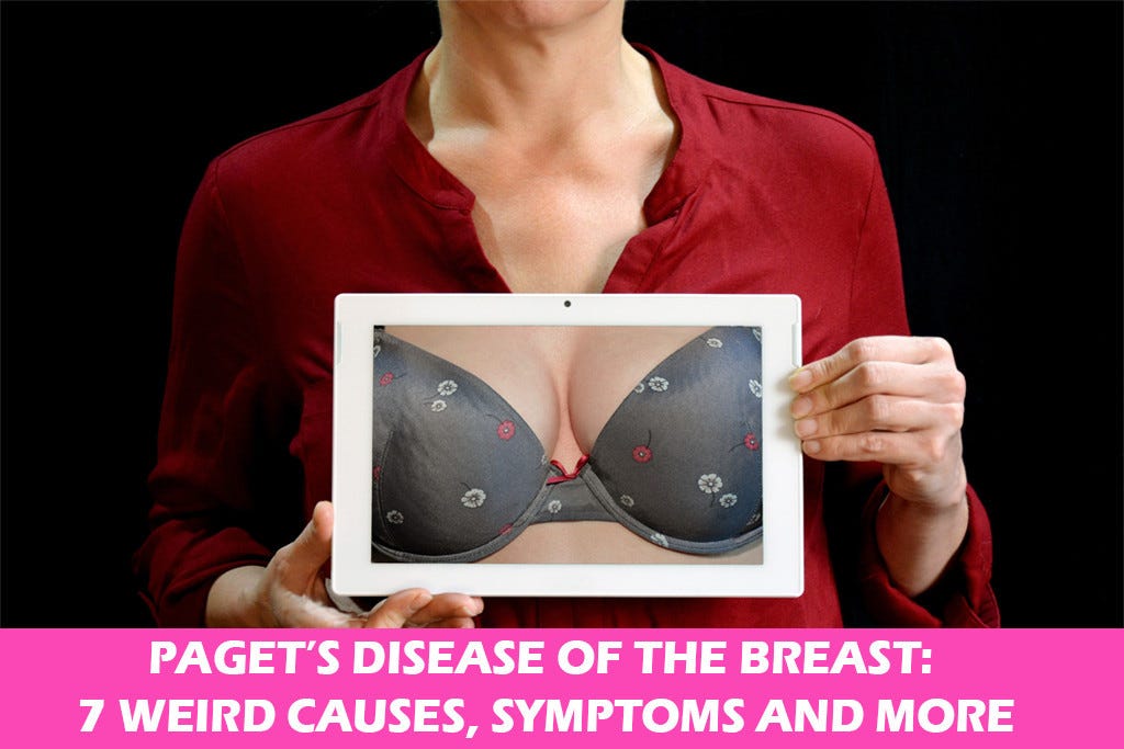 Paget’s Disease Of The Breast - Symptoms, Causes, And Diagnosis.