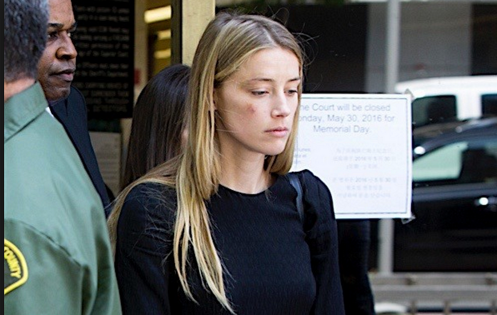 Amber Heard outside court with a noticably bruised cheek