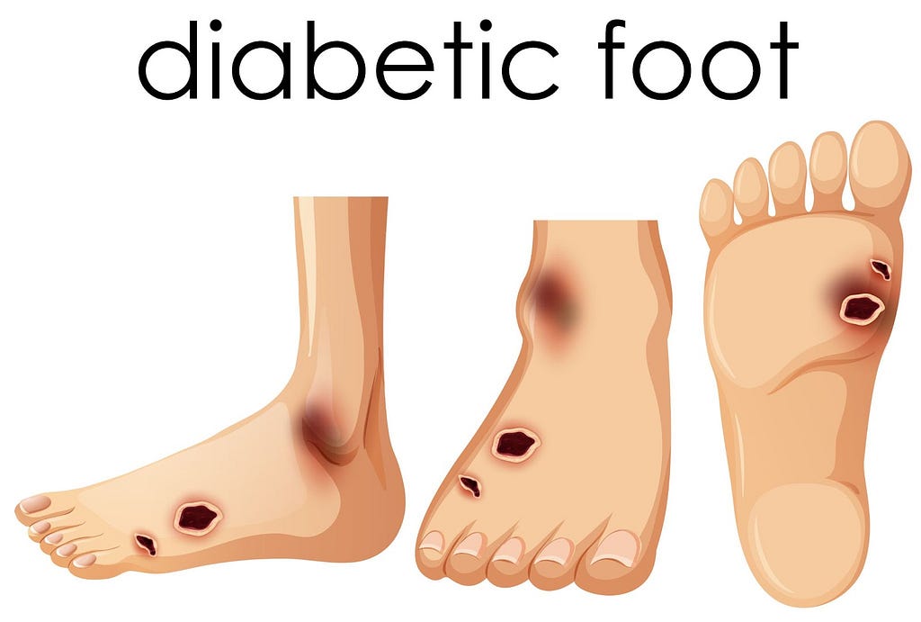A vector image of 3 feet with each foot displaying different site of infection.