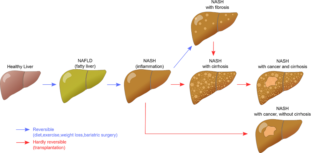 A vector image of different stages of fatty liver.
