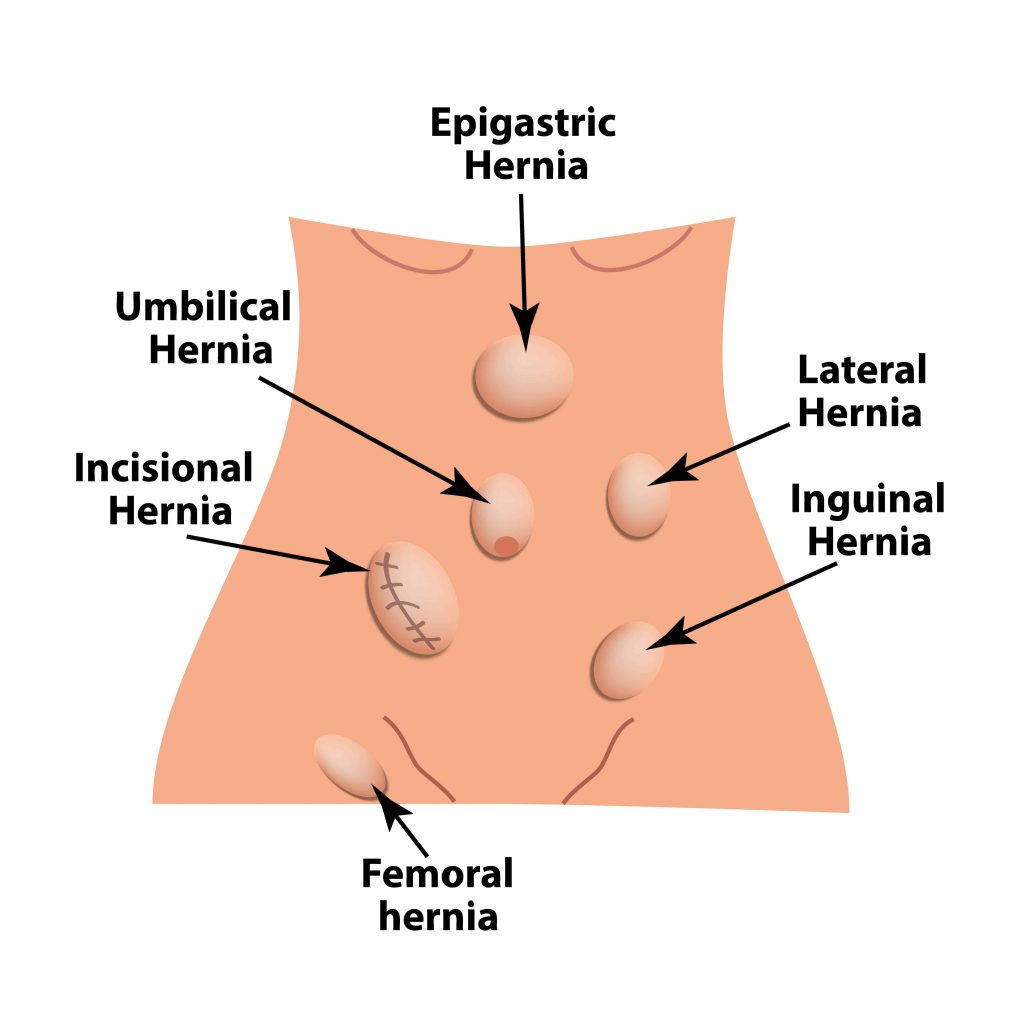 Hernia Repair Surgery — Laparoso obeso centre