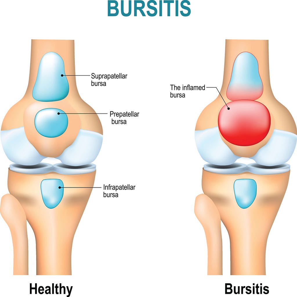 Treatment for Bursitis in Knee: Rapid Relief Tips