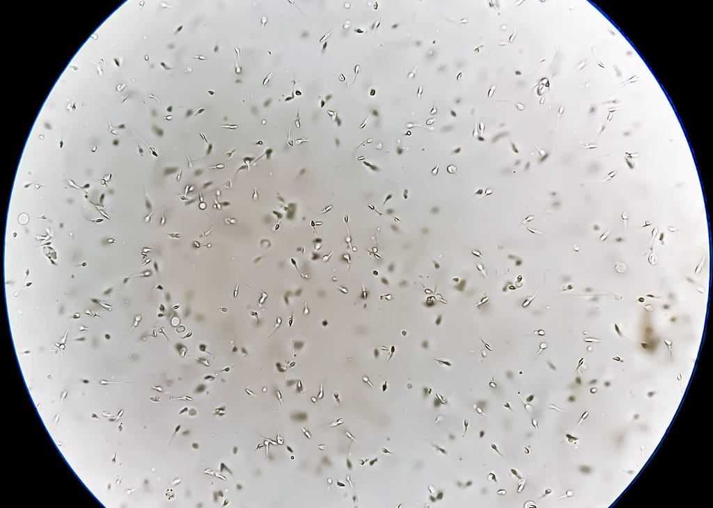 Semen analysis showing normal sperm count with morphology.