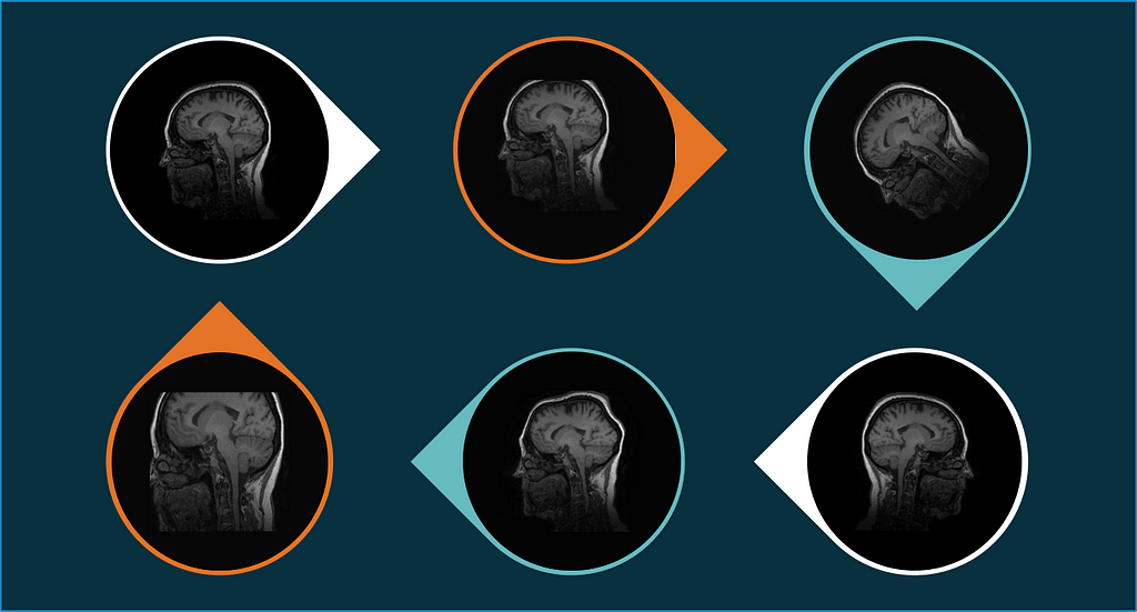 Image augmentation: how to overcome small radiology datasets