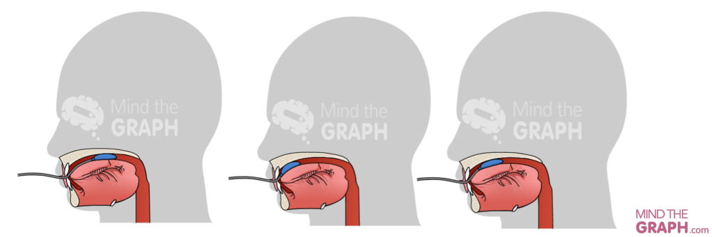 iopi tongue