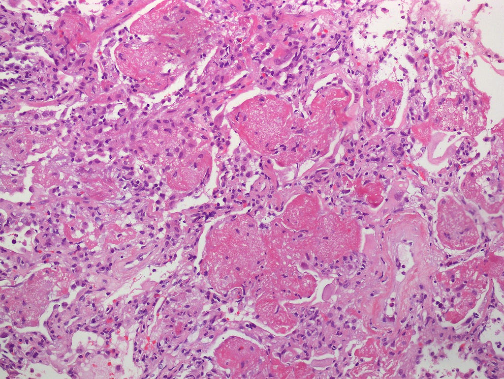 Covid Infected lung with alveoli full of gunk; Diagnostic Histopathology