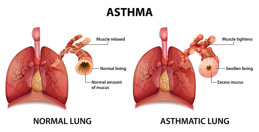 Asthma