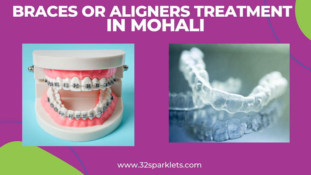 Braces or Aligners Treatment in Mohali — 32 Sparklets | Dentist In Mohali | Best Dentist in Mohali