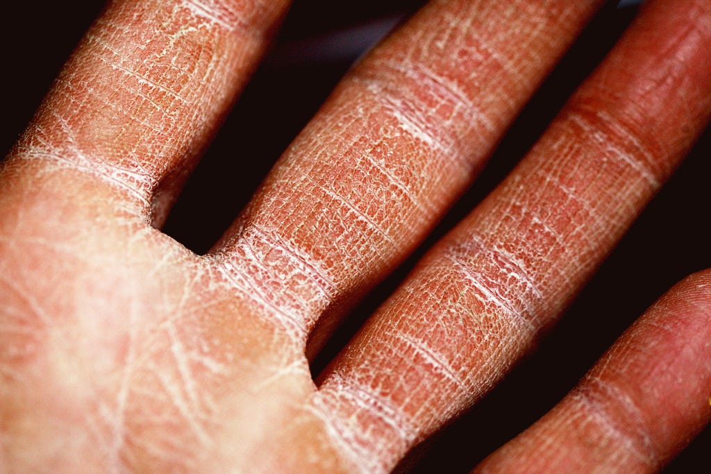 Palm of a person with very dry skin