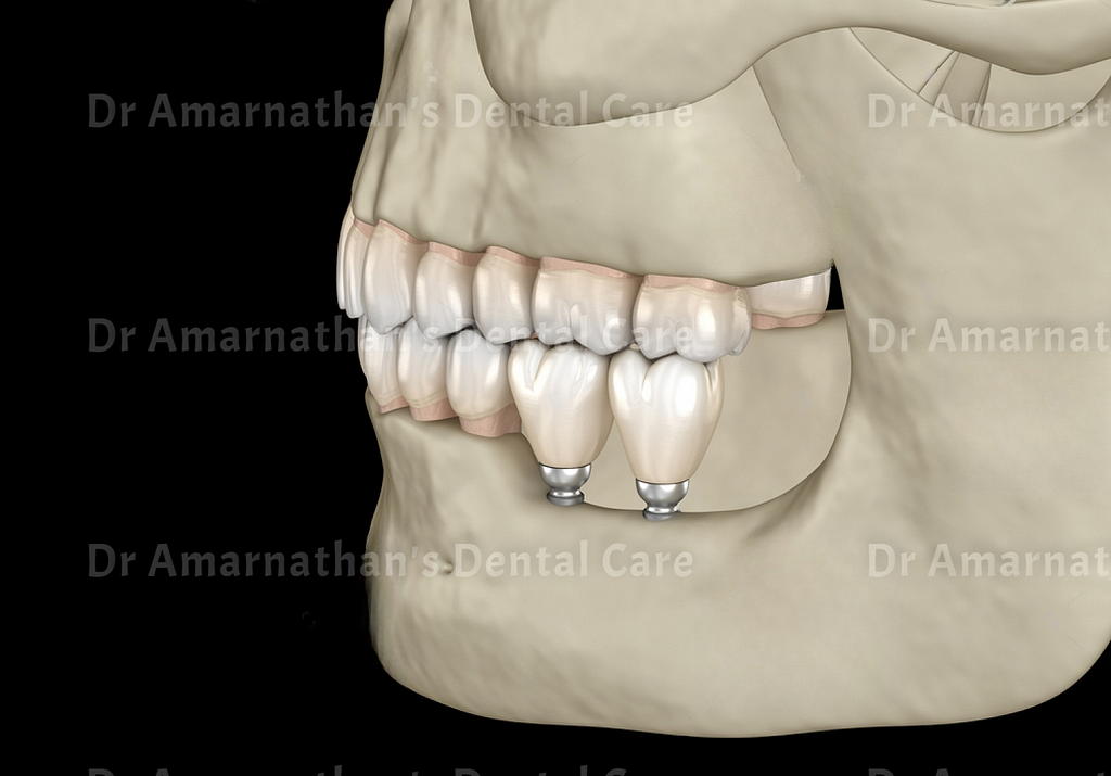 different types of dental implants