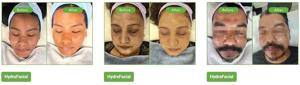 best hydrafacial result in kathmandu nepal