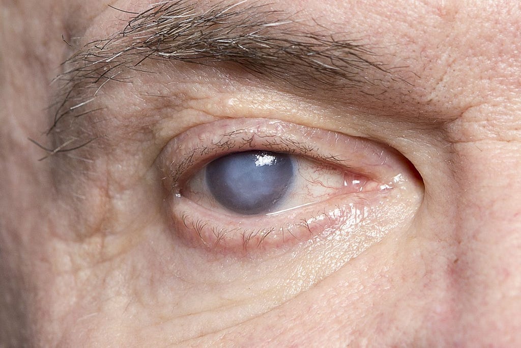 Cataract affected eye