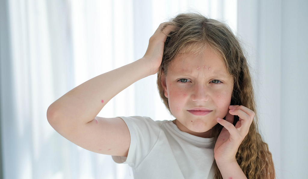 A girl scratching face because of allergy.