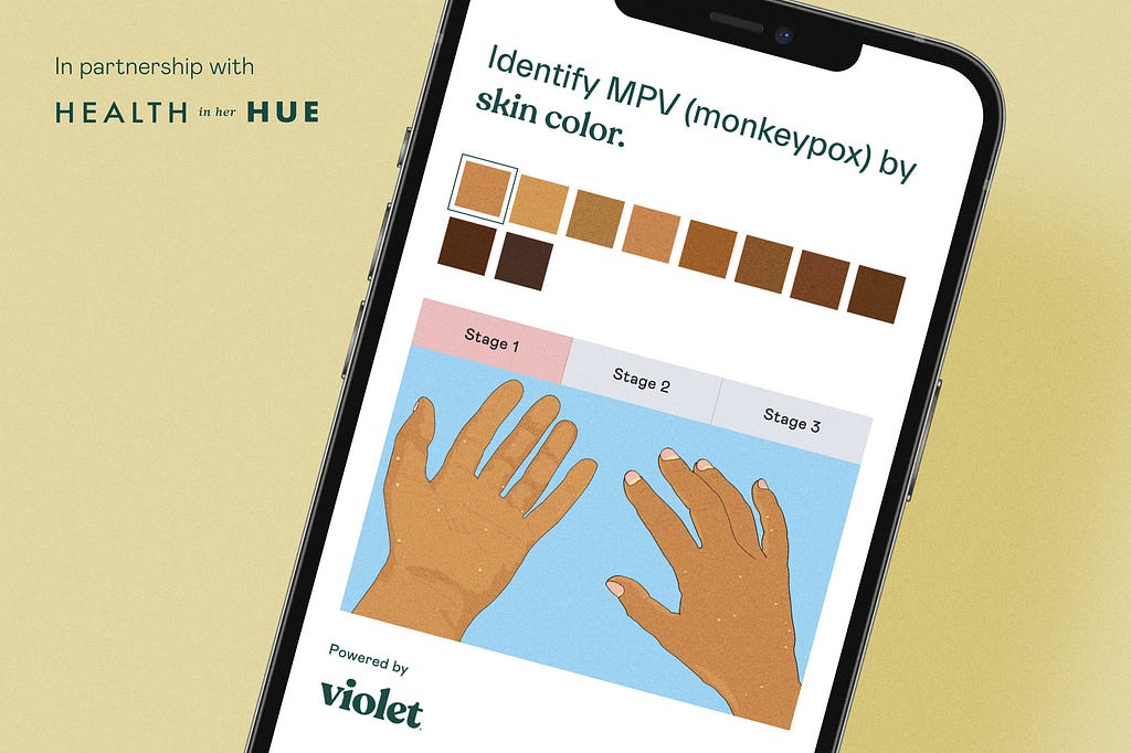 phone screen with interface for changing skin colors on hands with title “identify MPV (monkeypox) by skin color”